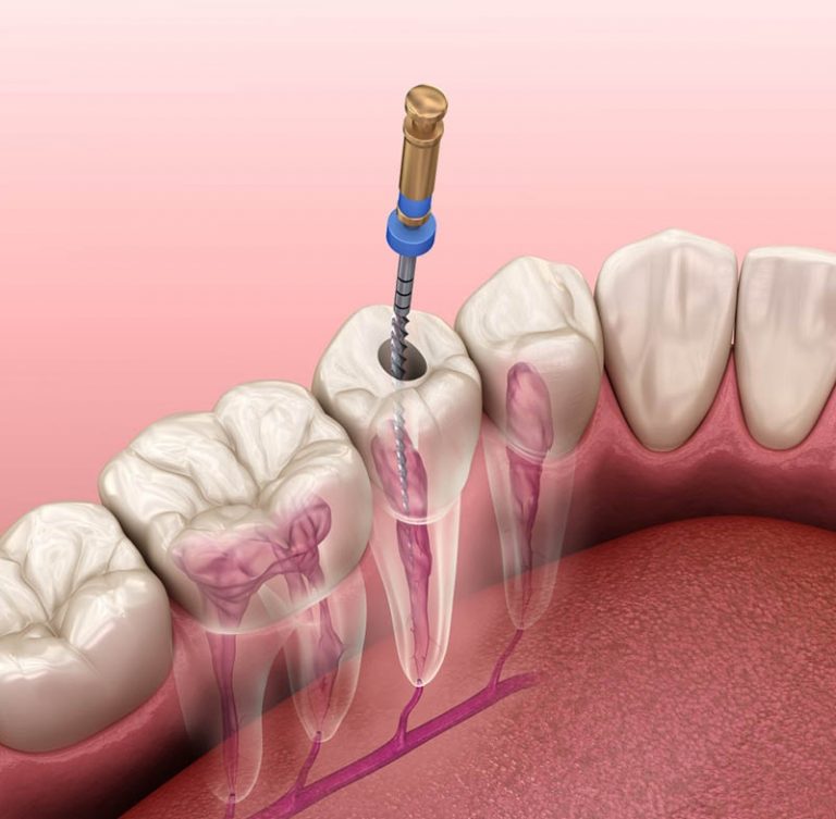 Điều Trị Tủy 1 Lần Hẹn (Nội Nha) Có Đau Không? Ưu Điểm & Quy Trình