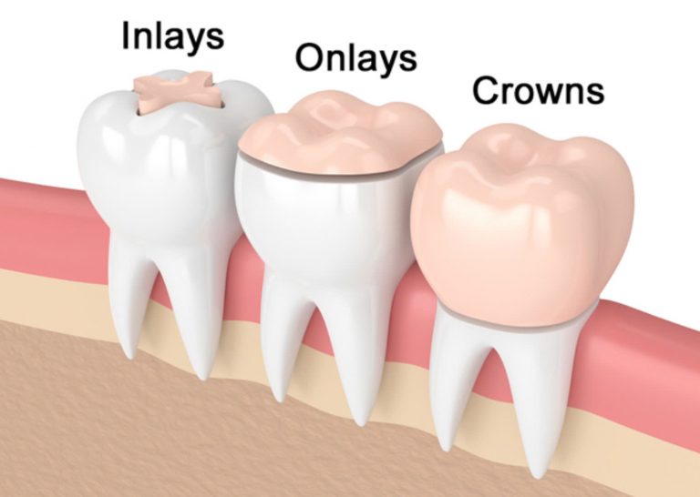 Phục Hình Dán Sứ Veneer Là Gì? Ưu Điểm & Quy Trình Bảo Tồn Răng Thật